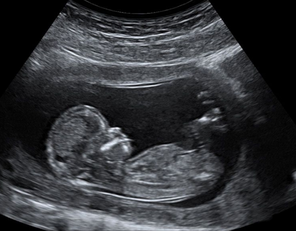 Ultrasound - Our Services - Early Scans